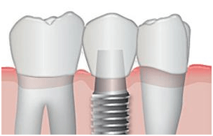 Dental Implants, Hawkesbury Dentists
