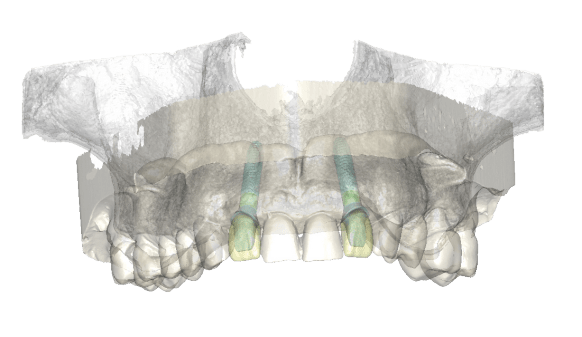 Simplant, Hawkesbury Dentists