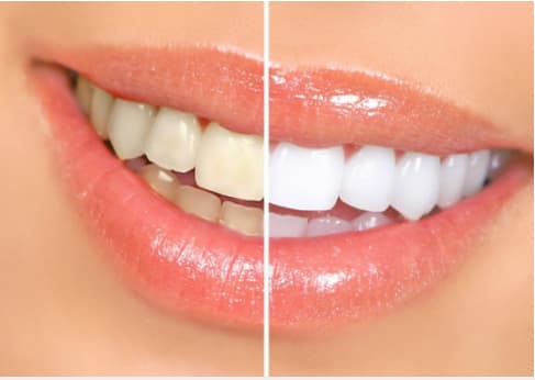 Teeth Whitening, Hawkesbury Dentists