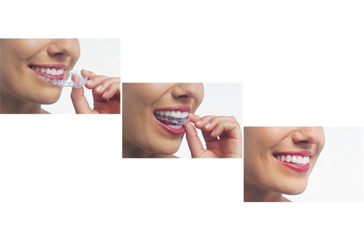 Invisalign, Hawkesbury Dentists